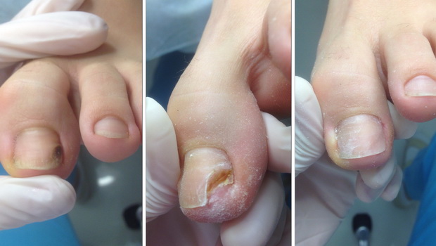Psoriasis nail changes Psoriasis toenail képek